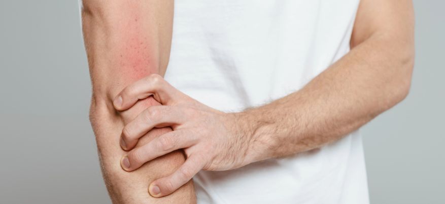 Irritazioni cutanee da sudore: cause, prevenzione e rimedi