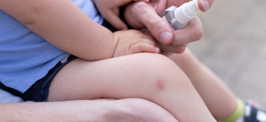 Punture di insetti: cosa sapere e come intervenire