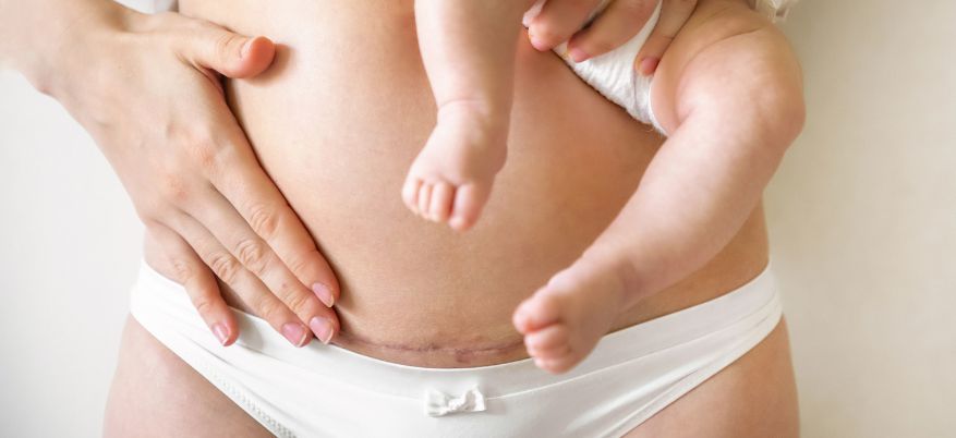 Cicatrice da cesareo: cosa sapere e come prendersene cura