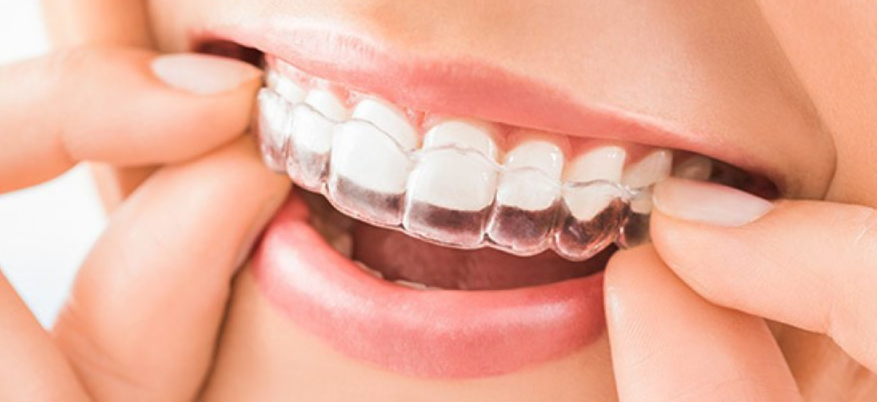 Stringi i denti di notte senza saperlo? Cosa fa il bruxismo alla tua salute e come fermarlo