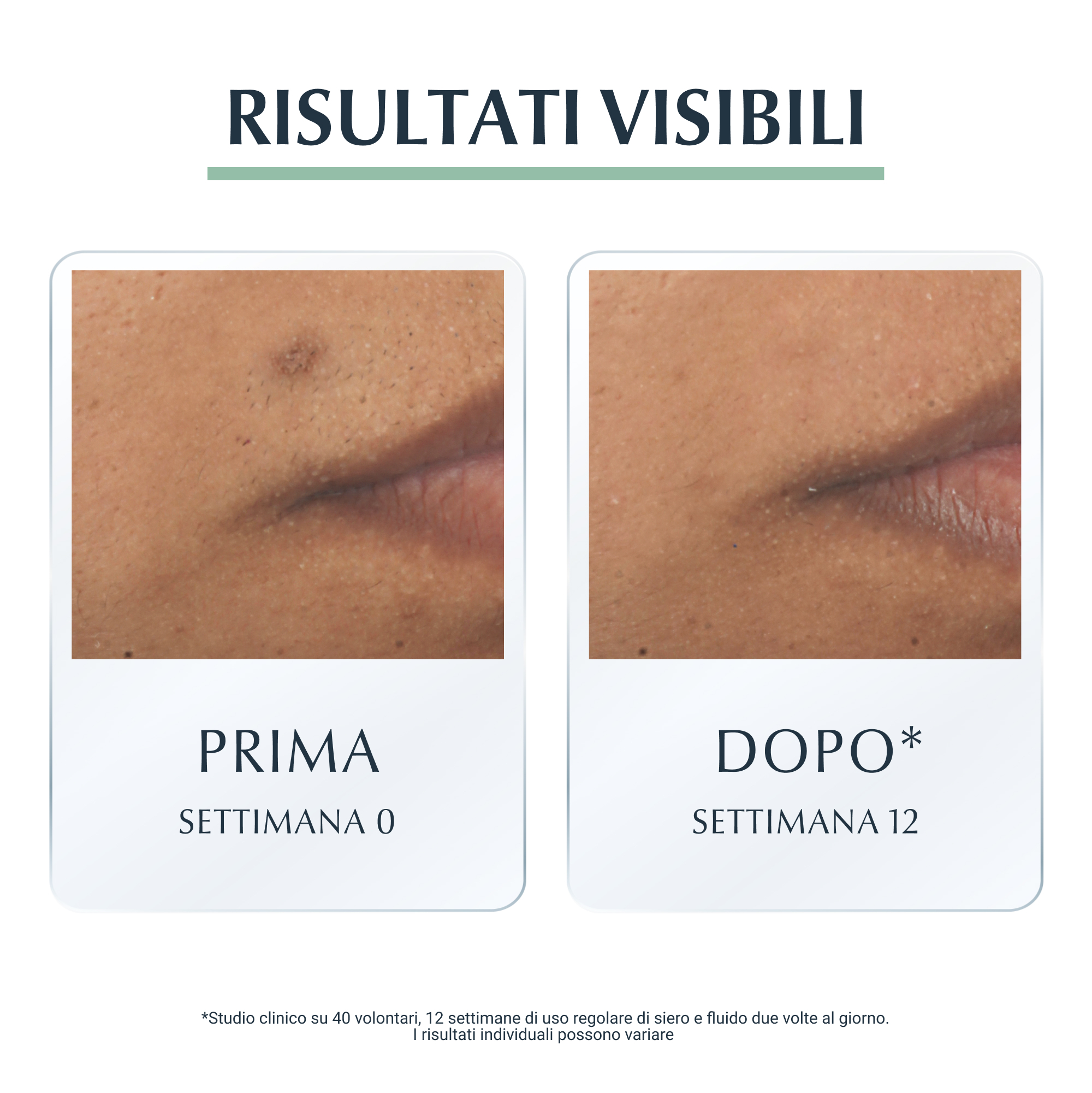 EUCERIN DermoPurifyer Siero Triplo Effetto per pelli con tendenza acneica - 40ml