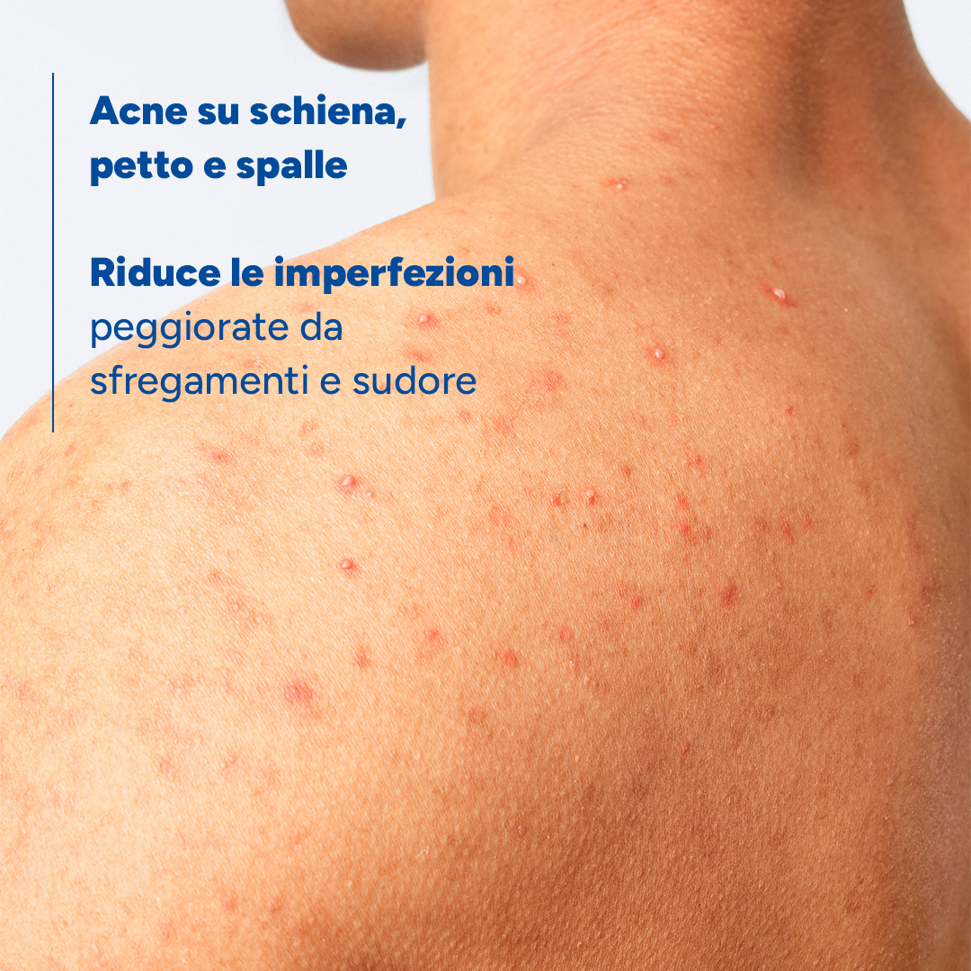 Ducray Keracnyl - Spray Disseccante Anti-Imperfezioni Corpo 150 ml