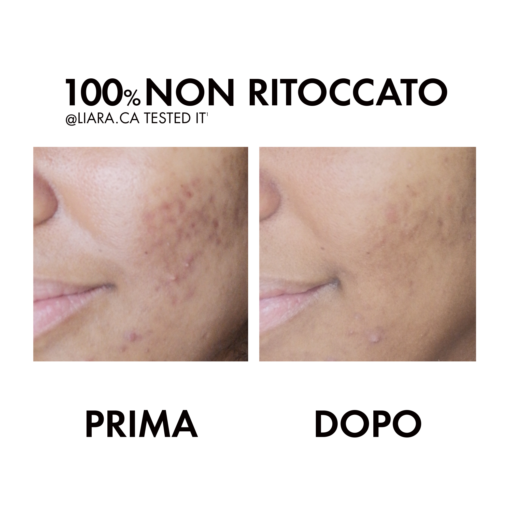 Vichy Normaderm Trattamento Idratante Doppia Azione per pelle a tendenza acneica 50 ml