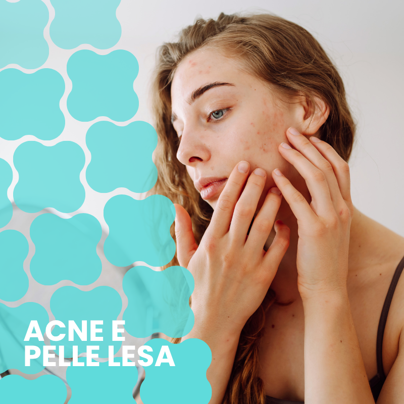 ACne Pelle lesa 800px
