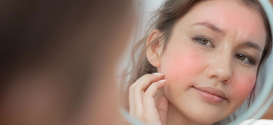 Rossori in viso: cause e rimedi efficaci per eliminarli