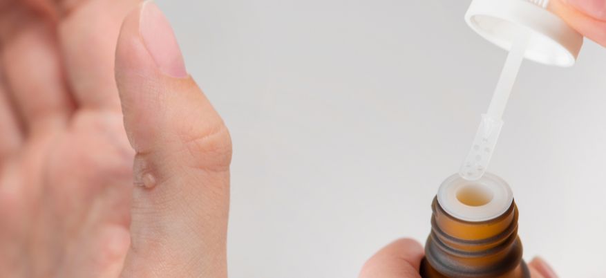 Verruche sulle mani: cause, contagio e trattamenti