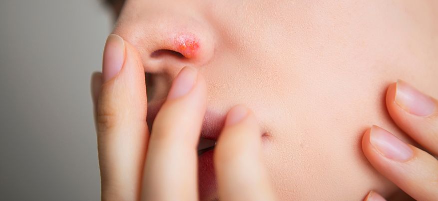 Herpes nasale: cause, rimedi e prevenzione