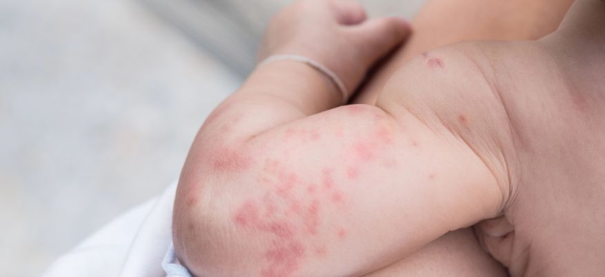 Orticaria nei bambini: cause, sintomi e rimedi efficaci