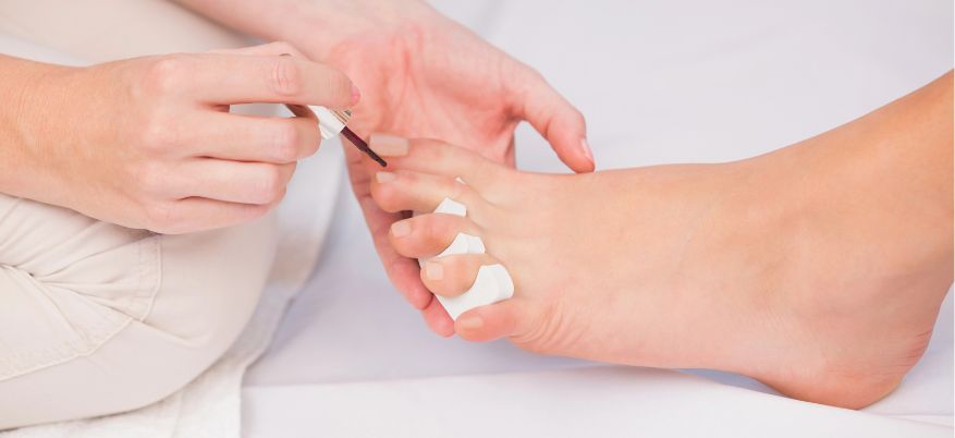 Smalti per onicomicosi: come funzionano e quando usarli