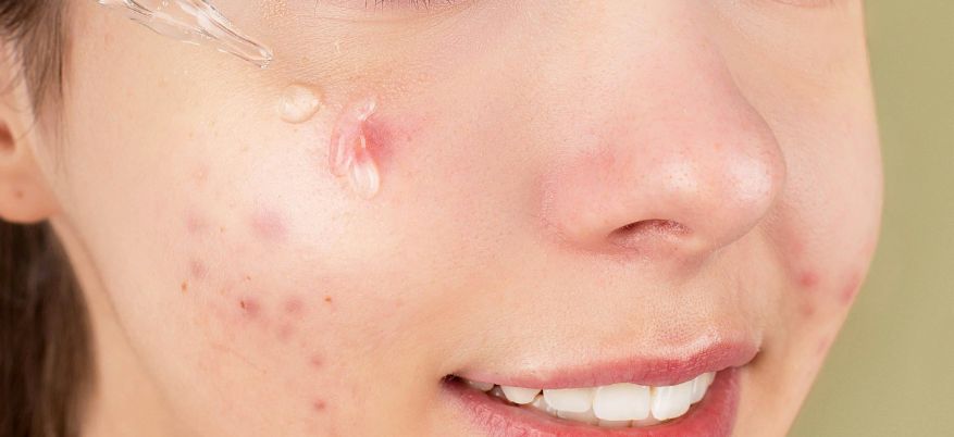 Acne in estate: come trattarla con i prodotti giusti