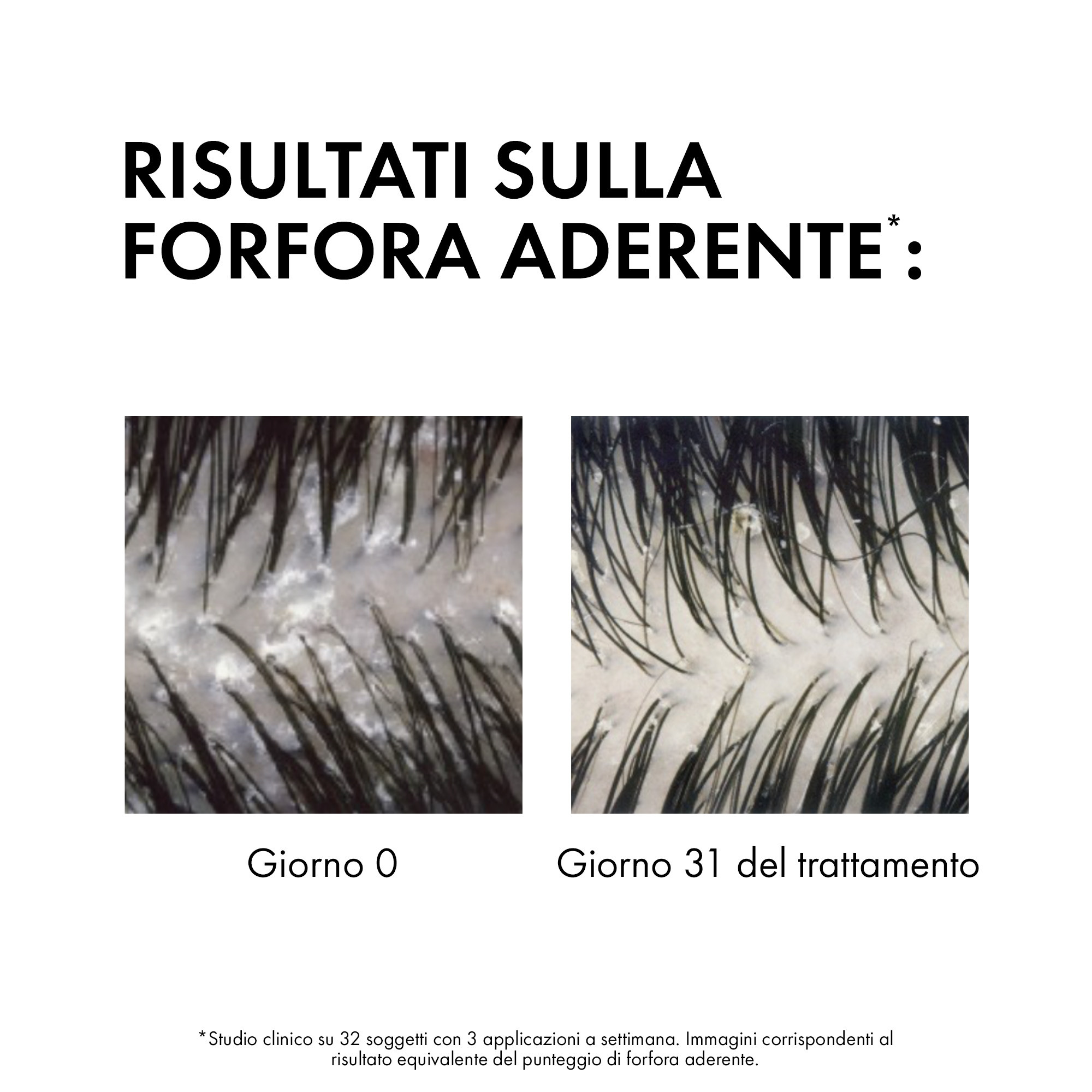 Vichy Dercos shampoo trattante antiforfora DS per capelli da normali a grassi eco ricarica 390ml
