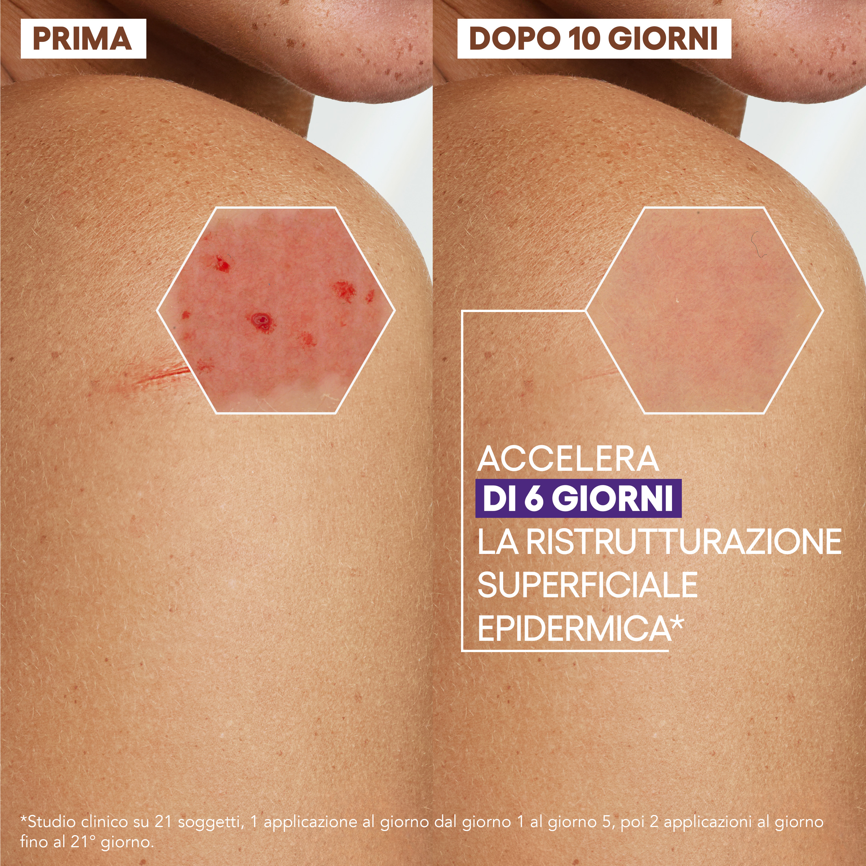 A-Derma Epitheliale Ultra Repair Crema ristrutturante anti-segni residui riparazione cutanea, lesioni cutanee, post-peeling, post laser, acido ialuronico, 40 ml