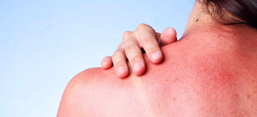 Prurito dopo l’abbronzatura: cause, rimedi e quando preoccuparsi