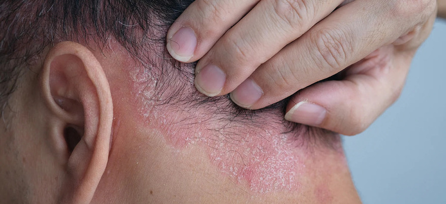 Shampoo per dermatite seborroica: come scegliere quello giusto