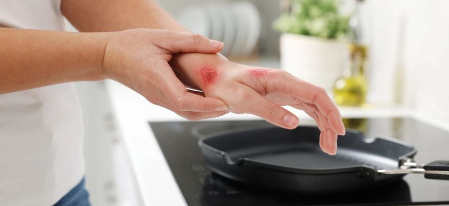 Cosa mettere sulle bruciature: rimedi utili e cosa fare subito