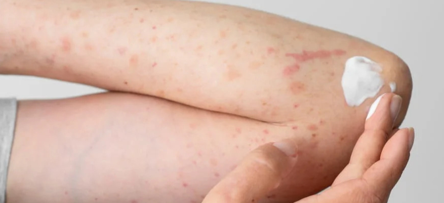 Cheratosi pilare: cause, rimedi e la routine skincare che funziona davvero