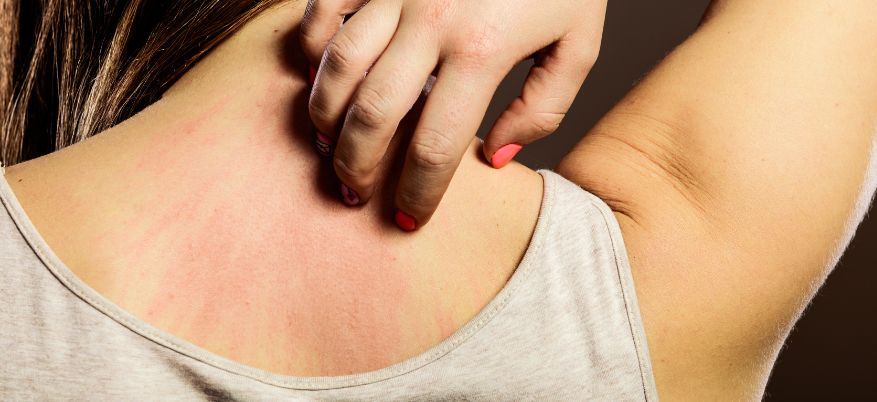 Allergia da contatto: sintomi e rimedi per trattarla