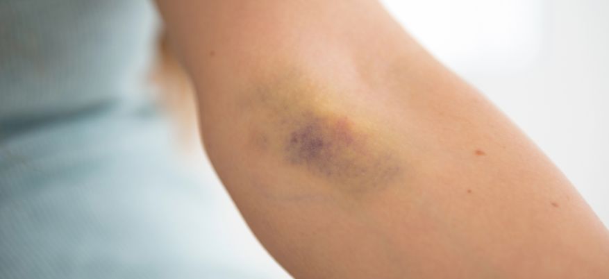 Cosa mettere sui lividi: rimedi efficaci e consigli