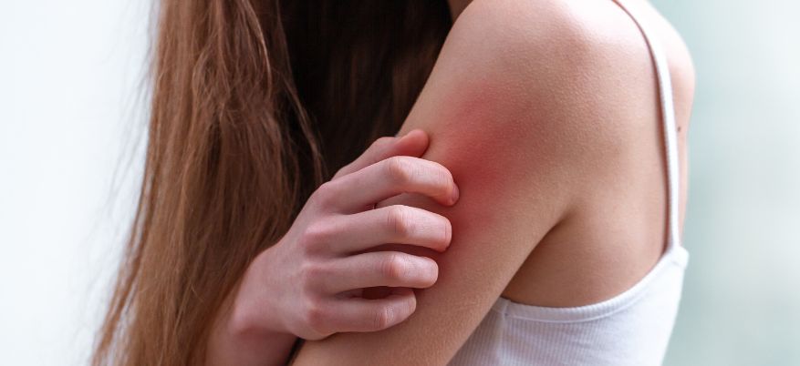 Eritema da contatto: come affrontare le irritazioni cutanee