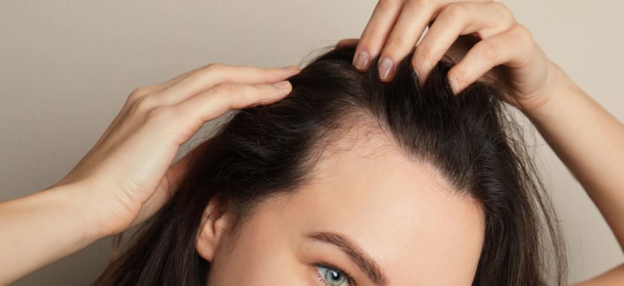 Alopecia femminile: cause, tipologie e trattamenti efficaci