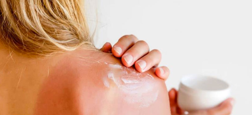 Scottatura solare: rimedi