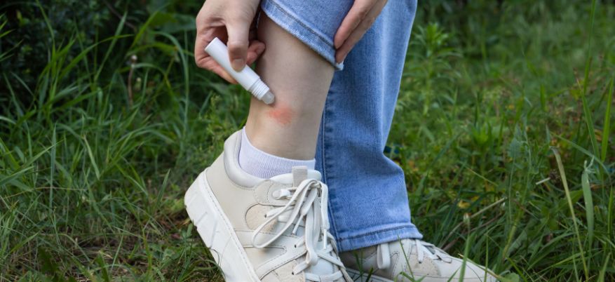 Rimedi dopopuntura efficaci: come alleviare prurito e gonfiore