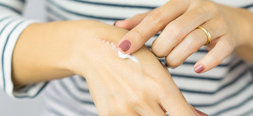 Crema schiarente per cicatrici: come funziona e quale scegliere
