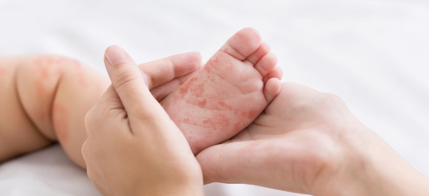 Sesta malattia nei bambini: cos'è e come si trasmette