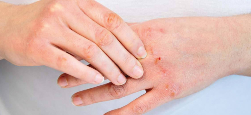 Allergia al nickel: alimenti, cosmetici e oggetti da controllare