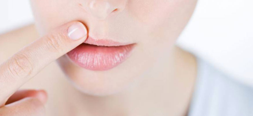 Herpes come curarlo