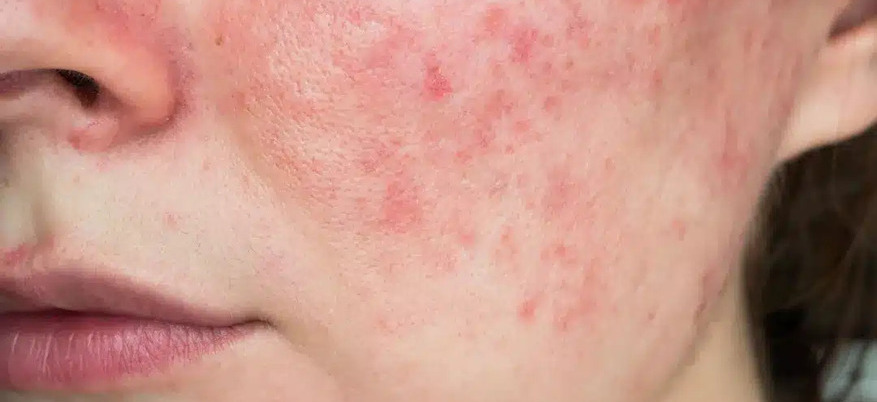 Rosacea e sole: come proteggere la pelle e prevenire i rossori