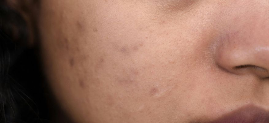 Cicatrici acneiche: come trattarle e prevenirle