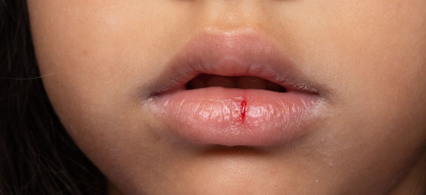 Labbra che si spaccano: cause, rimedi e prevenzione efficace