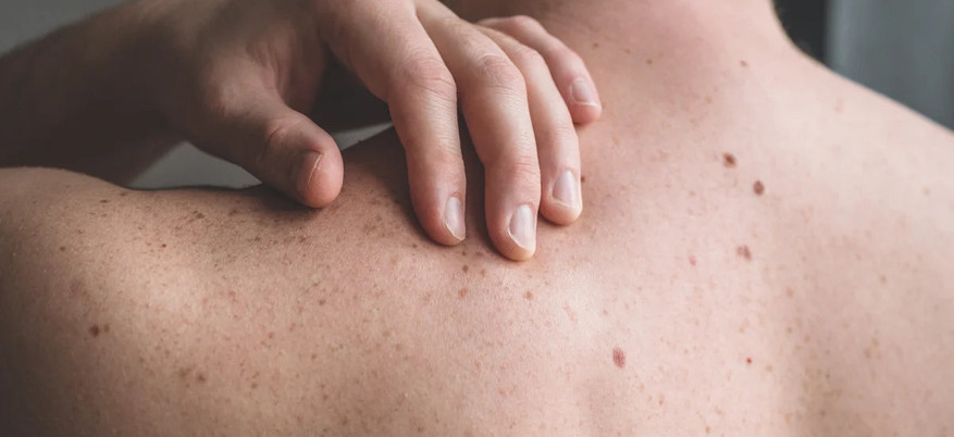 Protezione solare sui nei: quale SPF usare, come applicarla e quando rivolgersi al dermatologo