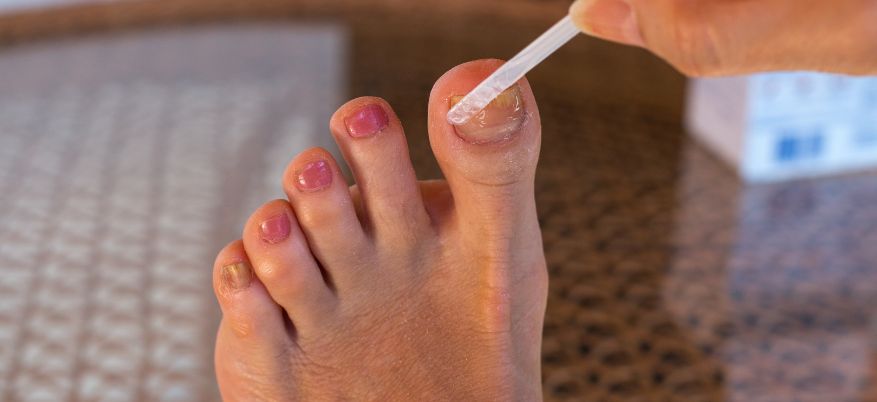 Micosi alle unghie dei piedi: cause, sintomi e rimedi