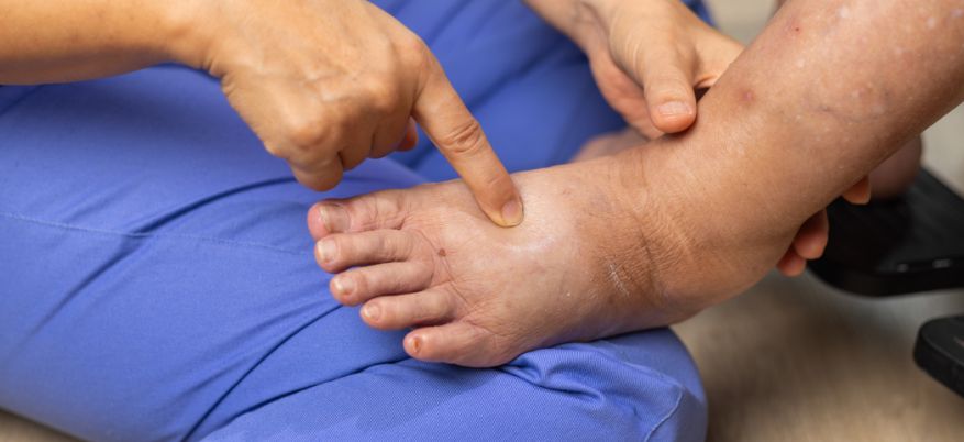 Piedi gonfi negli anziani: quando preoccuparsi e cosa fare