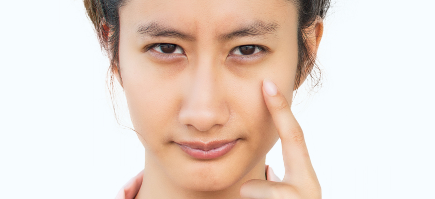 COME RIDURRE LE OCCHIAIE IN MODO NATURALE