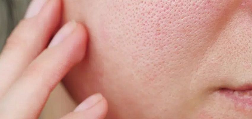 Creme per pelle grassa: come scegliere quella giusta