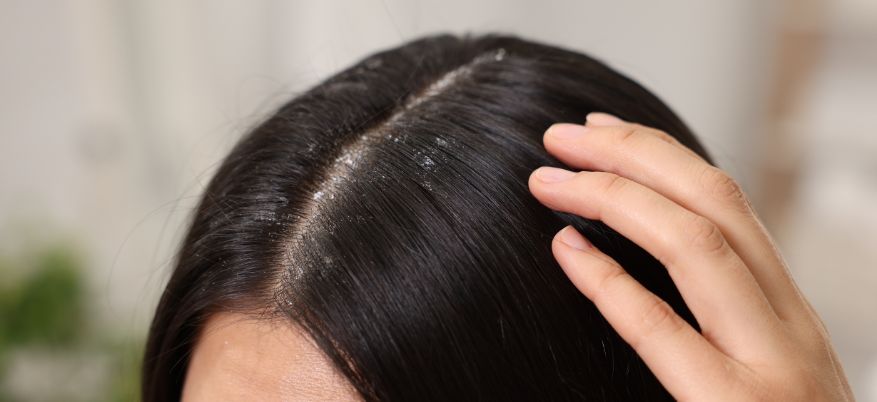 Rimedi per la cute secca: come prendersene cura