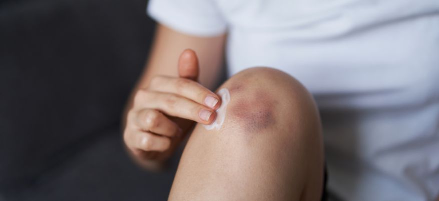Contusioni: cosa fare subito, rimedi utili e quando preoccuparsi