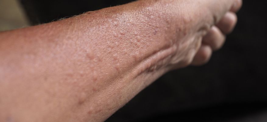 Allergia da contatto: sintomi, cause e rimedi